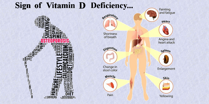 Can Low Levels Of Vitamin D Cause Serious Health Concerns 